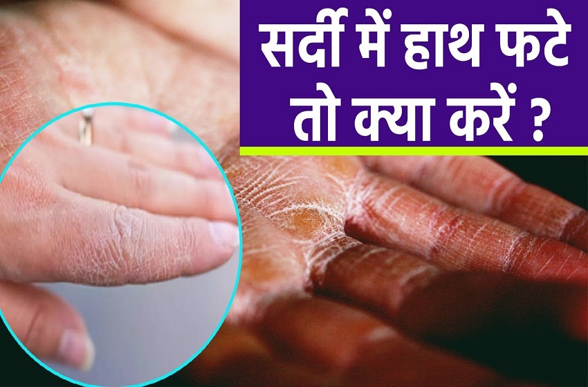 जरूरत की खबर- सर्दियों में फटते हाथ-पैर, रूखी होती त्वचा:हेल्दी स्किन के लिए खाएं ये चीजें, स्किन मॉश्चराइज करने की घरेलू टिप्स